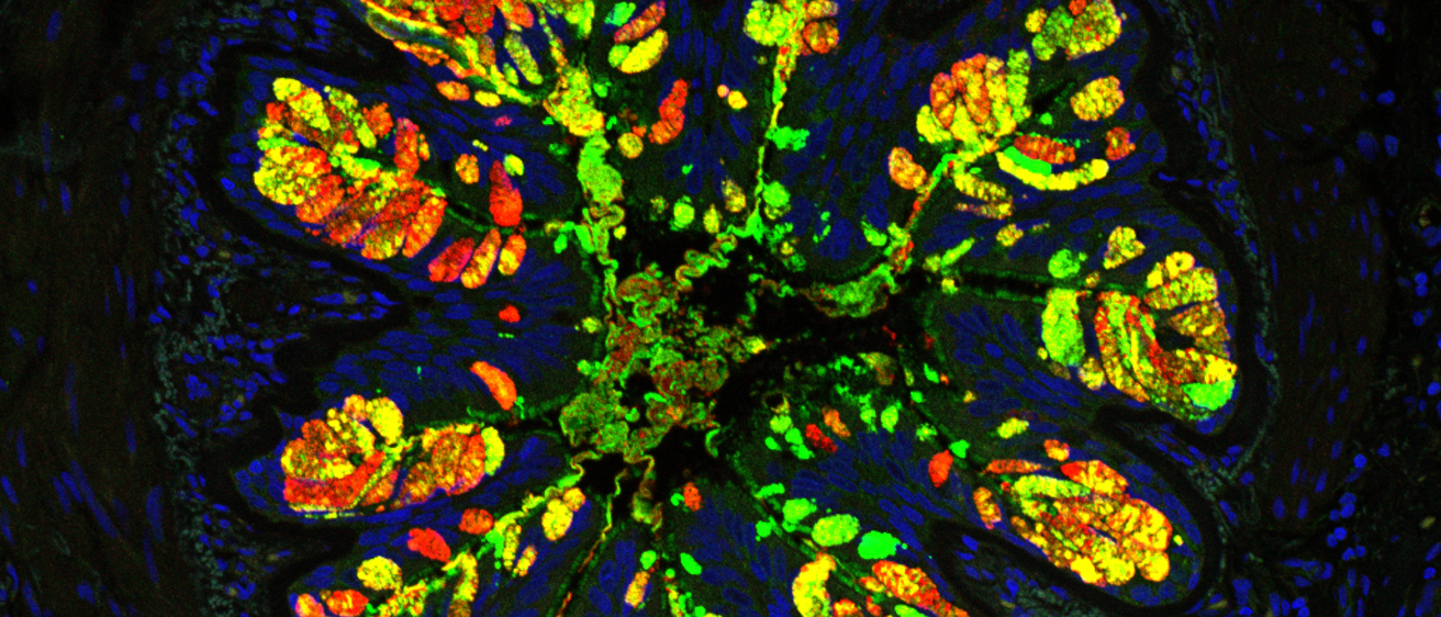 Mucins in fatal asthma